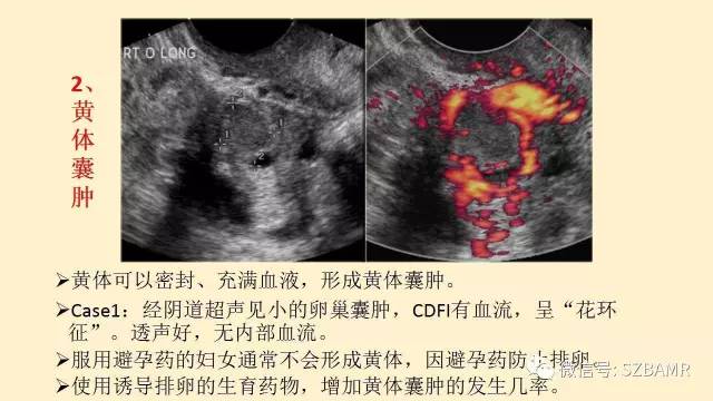 【PPT】卵巢常见囊性病变影像诊断