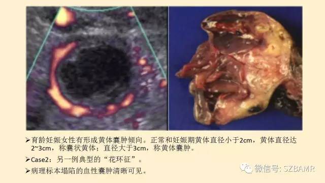 【PPT】卵巢常见囊性病变影像诊断