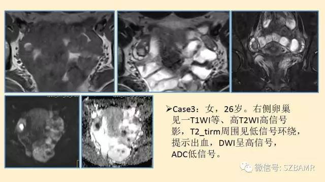 【PPT】卵巢常见囊性病变影像诊断