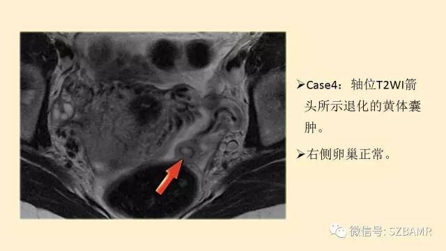 【PPT】卵巢常见囊性病变影像诊断