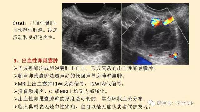 【PPT】卵巢常见囊性病变影像诊断