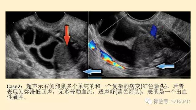 【PPT】卵巢常见囊性病变影像诊断