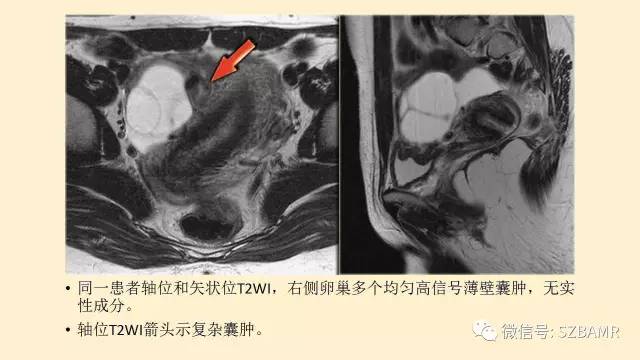 【PPT】卵巢常见囊性病变影像诊断