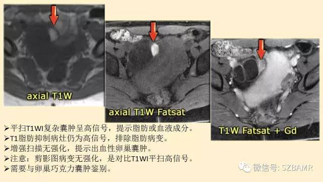 【PPT】卵巢常见囊性病变影像诊断