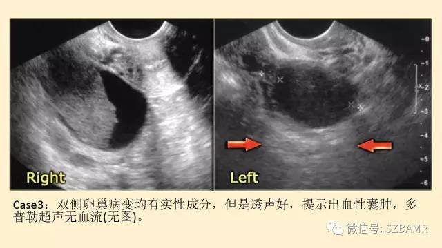 【PPT】卵巢常见囊性病变影像诊断