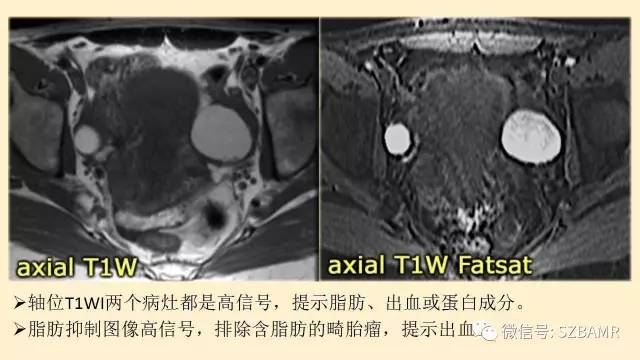 【PPT】卵巢常见囊性病变影像诊断