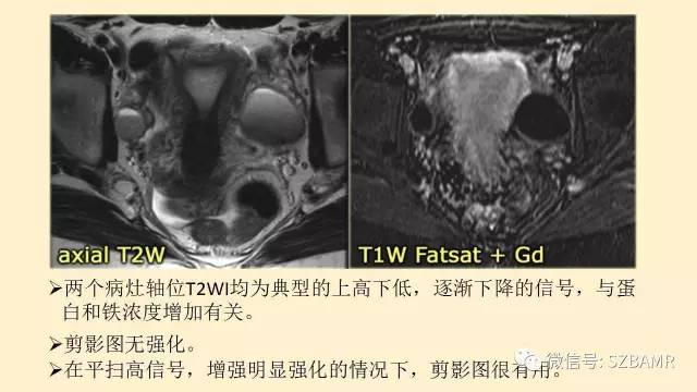 【PPT】卵巢常见囊性病变影像诊断