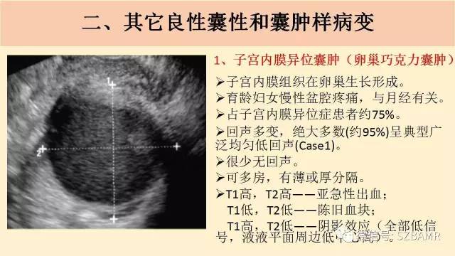 【PPT】卵巢常见囊性病变影像诊断