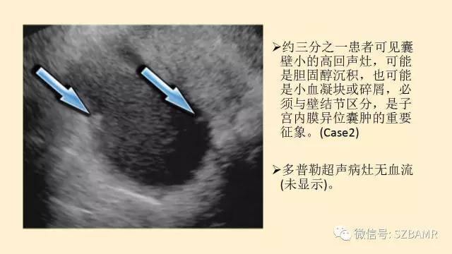 【PPT】卵巢常见囊性病变影像诊断