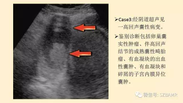 【PPT】卵巢常见囊性病变影像诊断