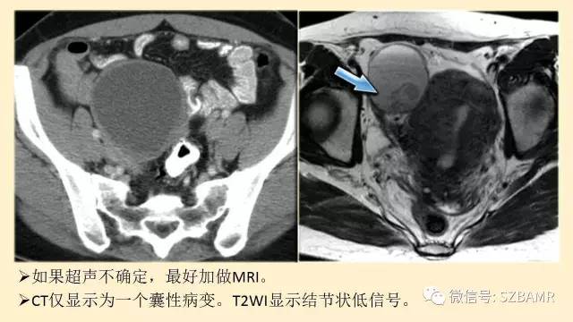 【PPT】卵巢常见囊性病变影像诊断