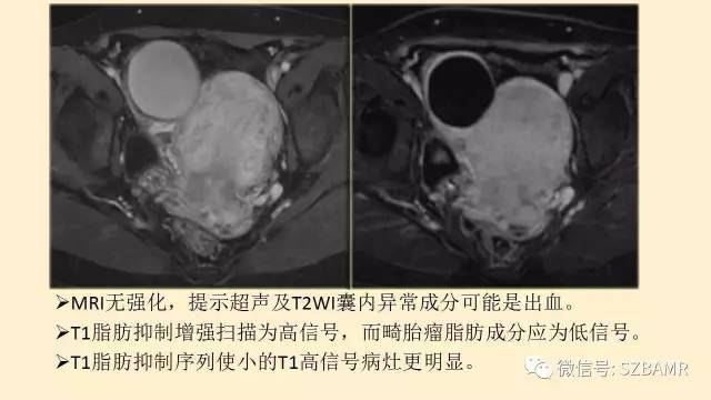 【PPT】卵巢常见囊性病变影像诊断