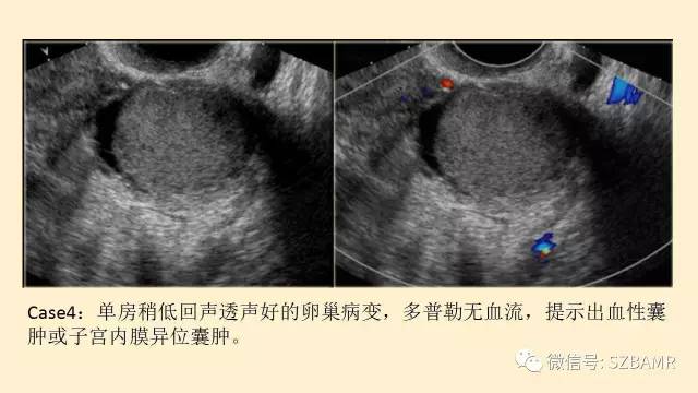 【PPT】卵巢常见囊性病变影像诊断