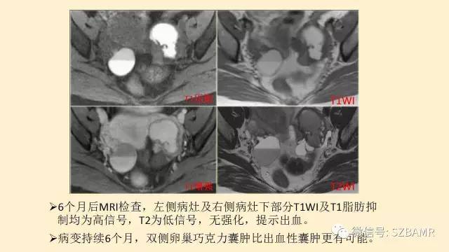 【PPT】卵巢常见囊性病变影像诊断