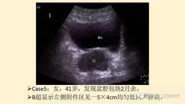 【PPT】卵巢常见囊性病变影像诊断