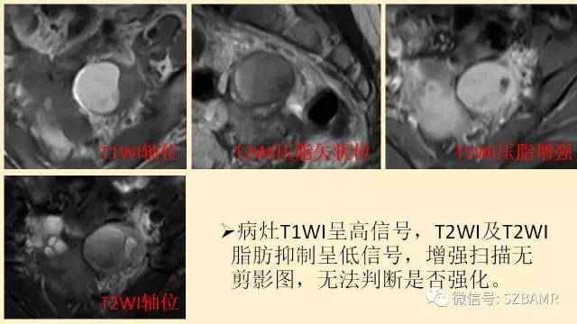 【PPT】卵巢常见囊性病变影像诊断