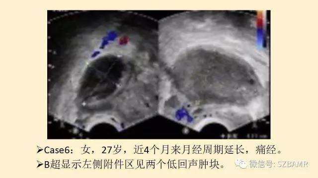 【PPT】卵巢常见囊性病变影像诊断