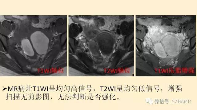 【PPT】卵巢常见囊性病变影像诊断
