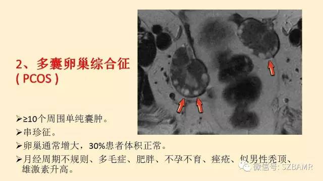 【PPT】卵巢常见囊性病变影像诊断
