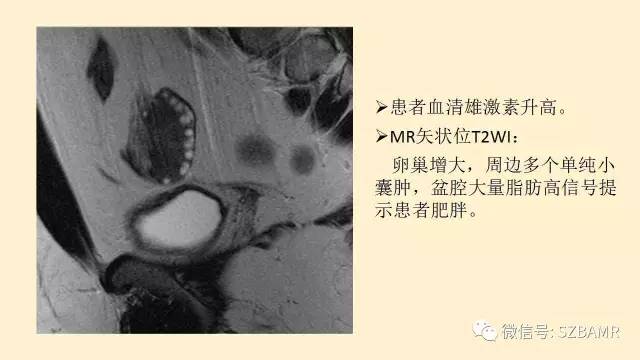 【PPT】卵巢常见囊性病变影像诊断
