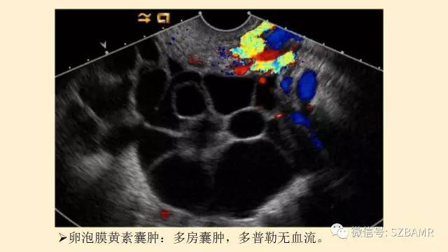 【PPT】卵巢常见囊性病变影像诊断