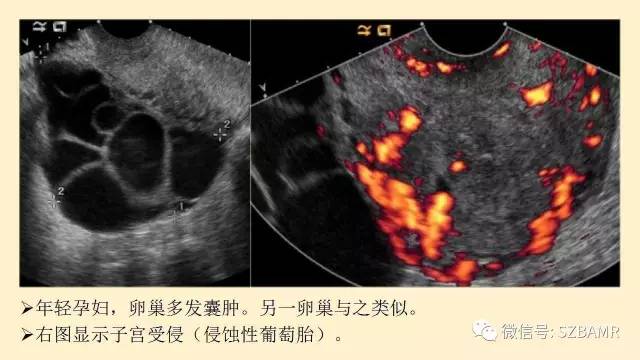 【PPT】卵巢常见囊性病变影像诊断