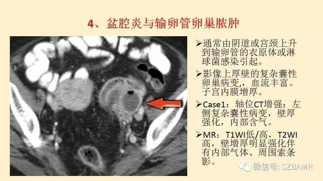 【PPT】卵巢常见囊性病变影像诊断