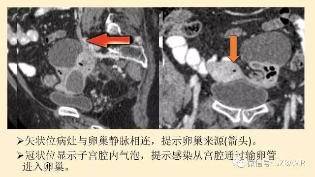 【PPT】卵巢常见囊性病变影像诊断