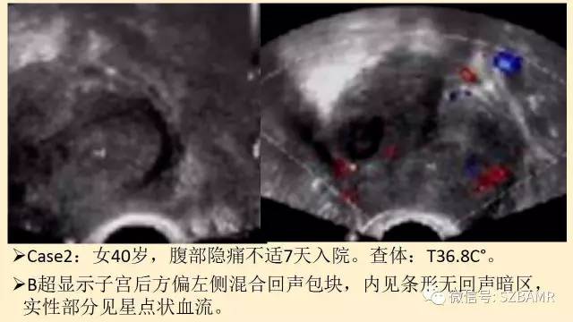 【PPT】卵巢常见囊性病变影像诊断