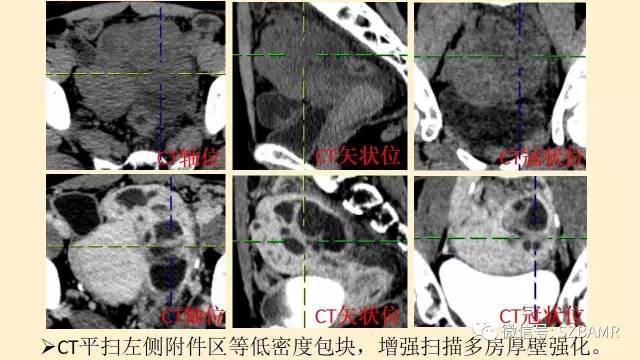 【PPT】卵巢常见囊性病变影像诊断