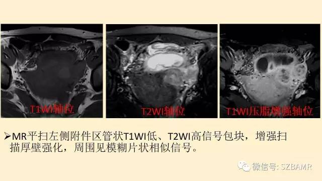 【PPT】卵巢常见囊性病变影像诊断