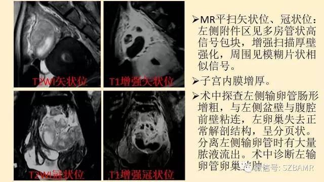 【PPT】卵巢常见囊性病变影像诊断