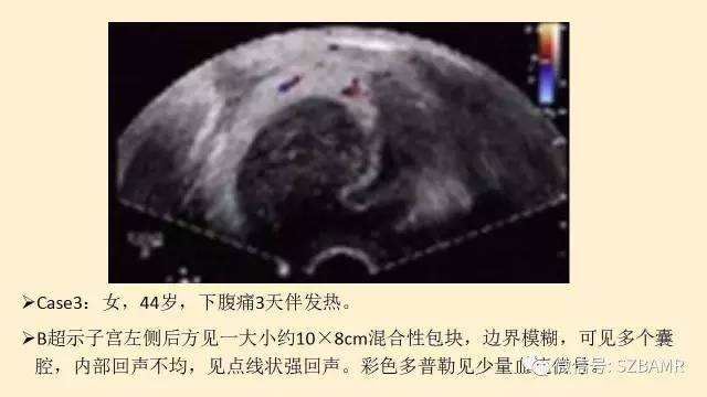 【PPT】卵巢常见囊性病变影像诊断