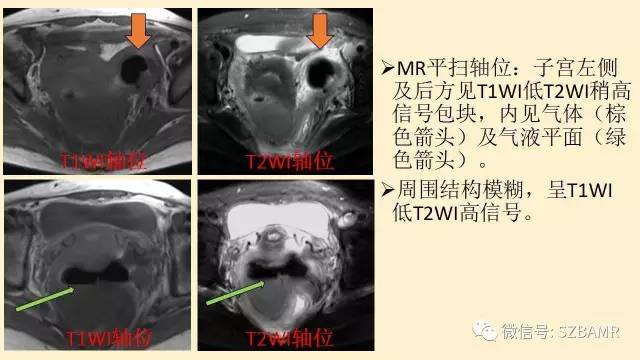 【PPT】卵巢常见囊性病变影像诊断