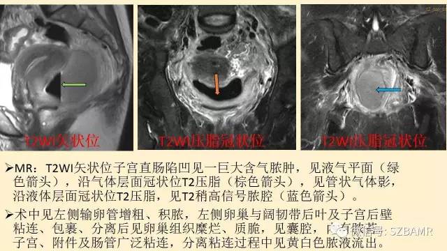 【PPT】卵巢常见囊性病变影像诊断