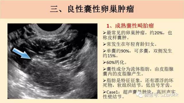 【PPT】卵巢常见囊性病变影像诊断
