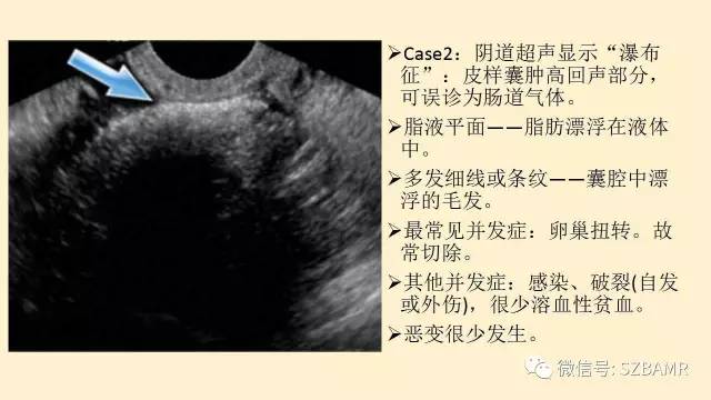 【PPT】卵巢常见囊性病变影像诊断