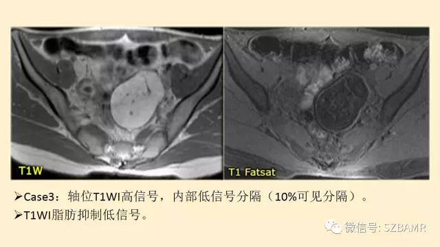 【PPT】卵巢常见囊性病变影像诊断
