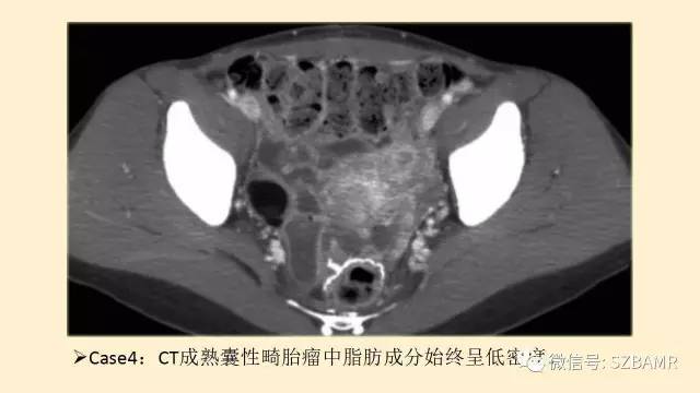 【PPT】卵巢常见囊性病变影像诊断