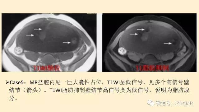 【PPT】卵巢常见囊性病变影像诊断