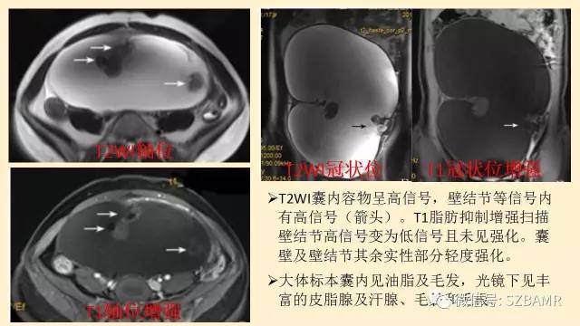 【PPT】卵巢常见囊性病变影像诊断