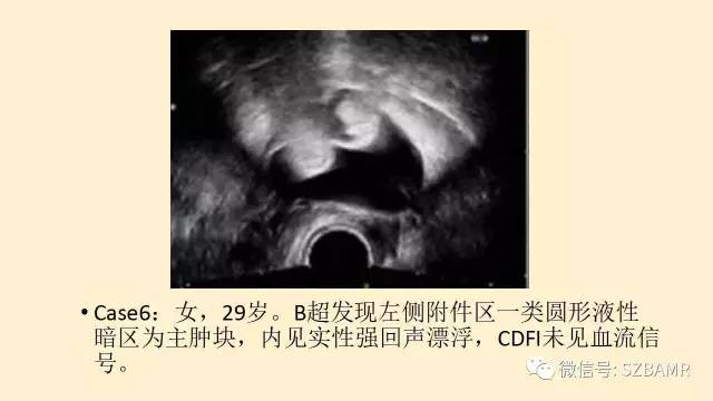【PPT】卵巢常见囊性病变影像诊断