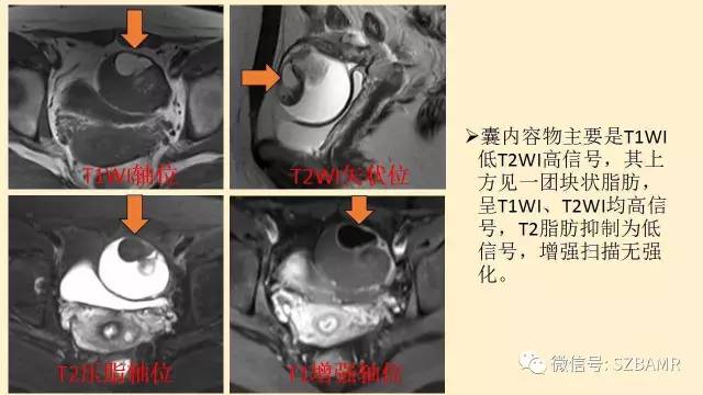 【PPT】卵巢常见囊性病变影像诊断