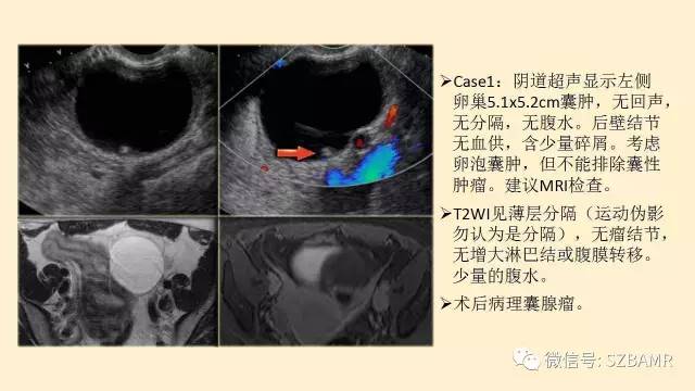 【PPT】卵巢常见囊性病变影像诊断