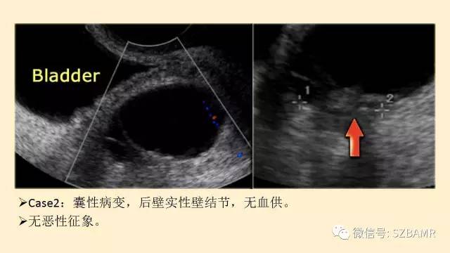 【PPT】卵巢常见囊性病变影像诊断