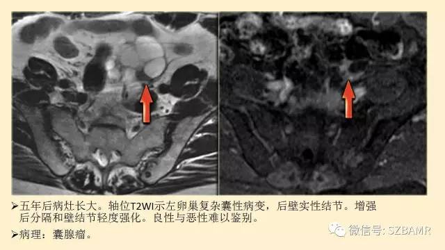 【PPT】卵巢常见囊性病变影像诊断