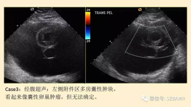 【PPT】卵巢常见囊性病变影像诊断