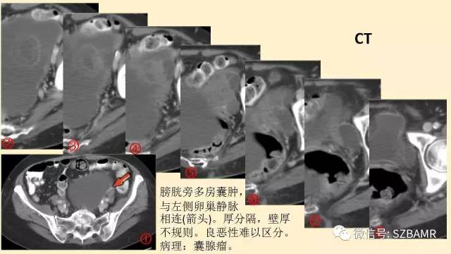 【PPT】卵巢常见囊性病变影像诊断