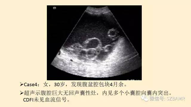 【PPT】卵巢常见囊性病变影像诊断