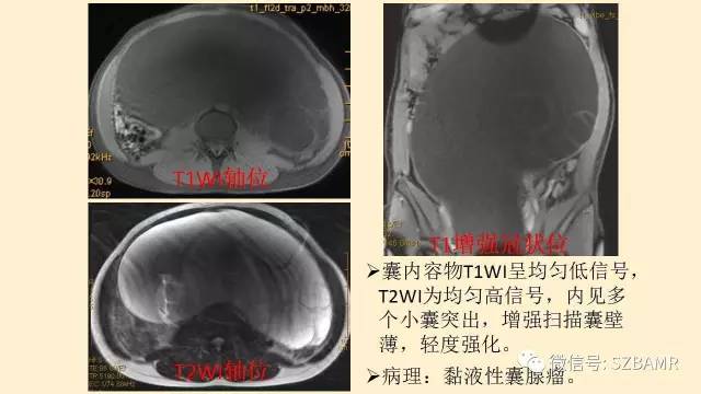 【PPT】卵巢常见囊性病变影像诊断